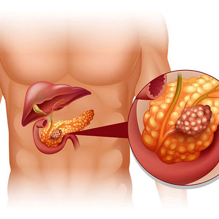 Acute pancreatitis in Secunderabad